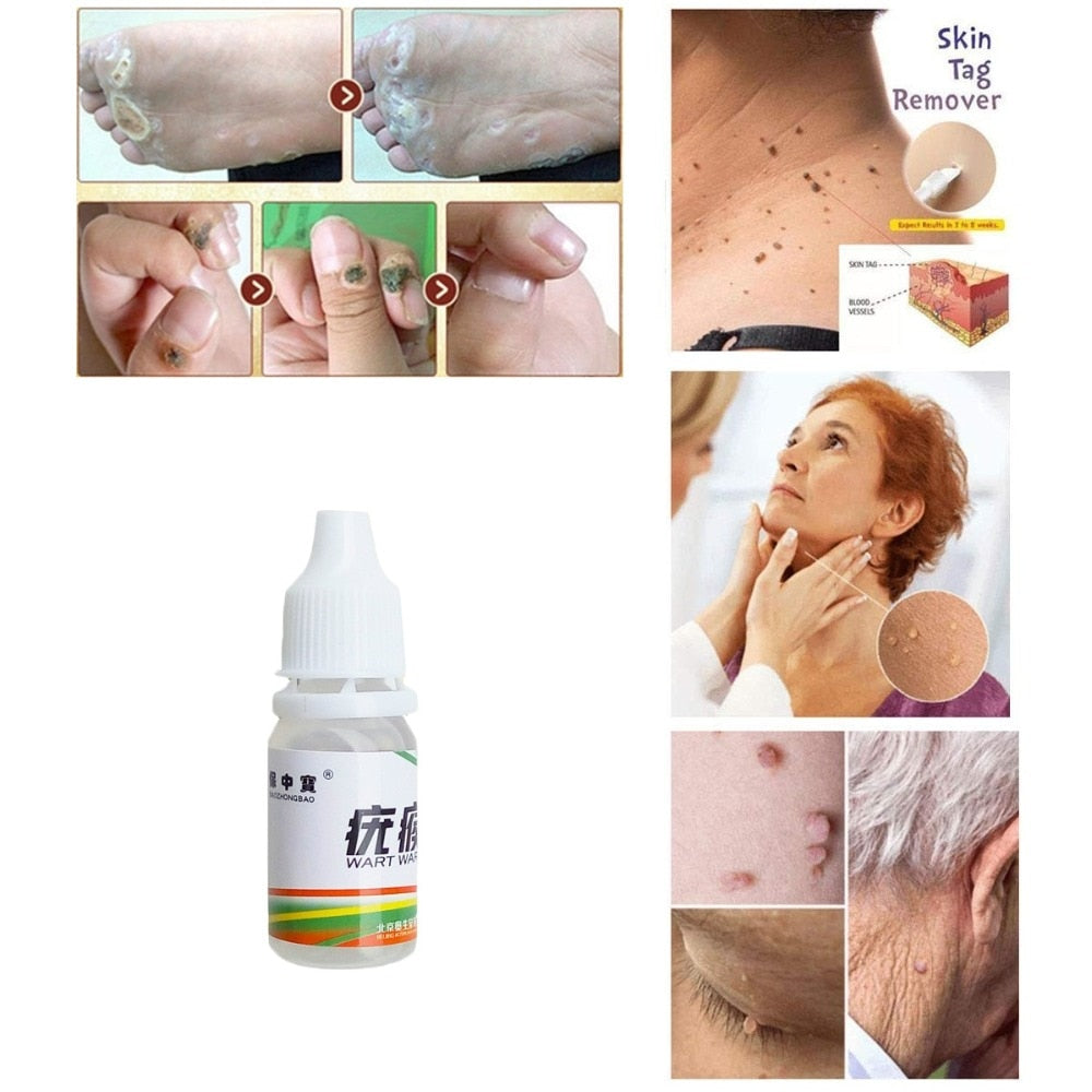 Body Warts Treatment Cream Skin Tag Remover Foot Corn Removal Plantar Genital Warts Ointment Foot Care Cream 10ML